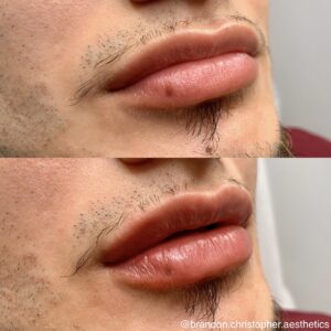 Lip Augmentation